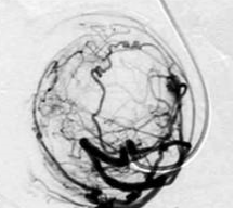 3子宫腺肌症子宫肌瘤2623.png